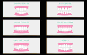 SCM Bellecour - Orthodontie invisible - les cas traitables