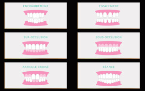 SCM Bellecour - Orthodontie invisible - les cas traitables