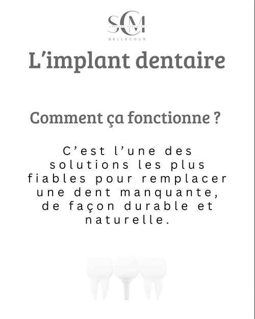 SCM Bellecour - L'implant dentaire : Comment ca fonctionne ?