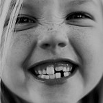 SCM Bellecour - les dents de lait : Résorption des gencives