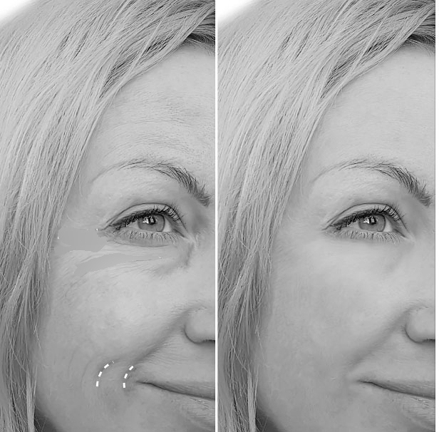 SCM Bellecour - Classic Lidocaine -corrections rides